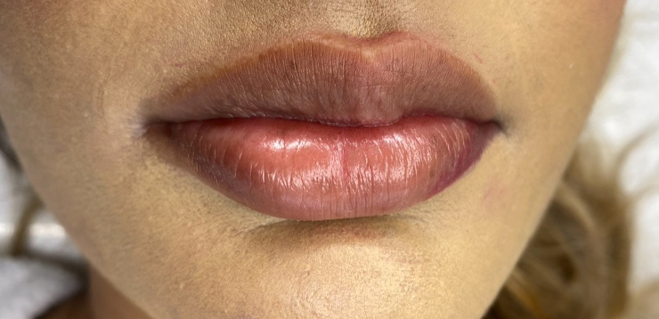 before-lip-neutalization-correction